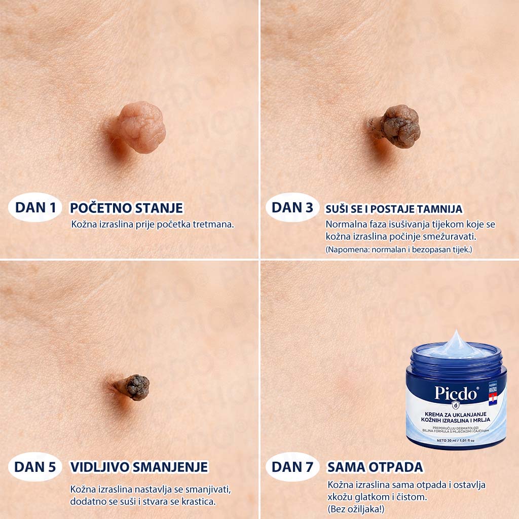 𝐏𝐢𝐜𝐝𝐨®🧑‍⚕️ 7-dnevna 𝐤𝐫𝐞𝐦𝐚 𝐳𝐚 𝐤𝐨ž𝐧𝐞 𝐢𝐳𝐫𝐚𝐬𝐭𝐚𝐣𝐞 & 𝐩𝐢𝐠𝐦𝐞𝐧𝐭𝐚𝐜𝐢𝐣𝐬𝐤𝐞 𝐦𝐫𝐥𝐣𝐞 (bezbolna formula – bez ožiljaka)🎁