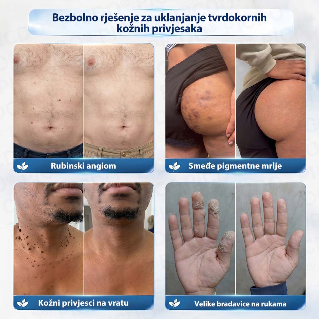 𝐏𝐢𝐜𝐝𝐨®🧑‍⚕️ 7-dnevna 𝐤𝐫𝐞𝐦𝐚 𝐳𝐚 𝐤𝐨ž𝐧𝐞 𝐢𝐳𝐫𝐚𝐬𝐭𝐚𝐣𝐞 & 𝐩𝐢𝐠𝐦𝐞𝐧𝐭𝐚𝐜𝐢𝐣𝐬𝐤𝐞 𝐦𝐫𝐥𝐣𝐞 (bezbolna formula – bez ožiljaka)🎁
