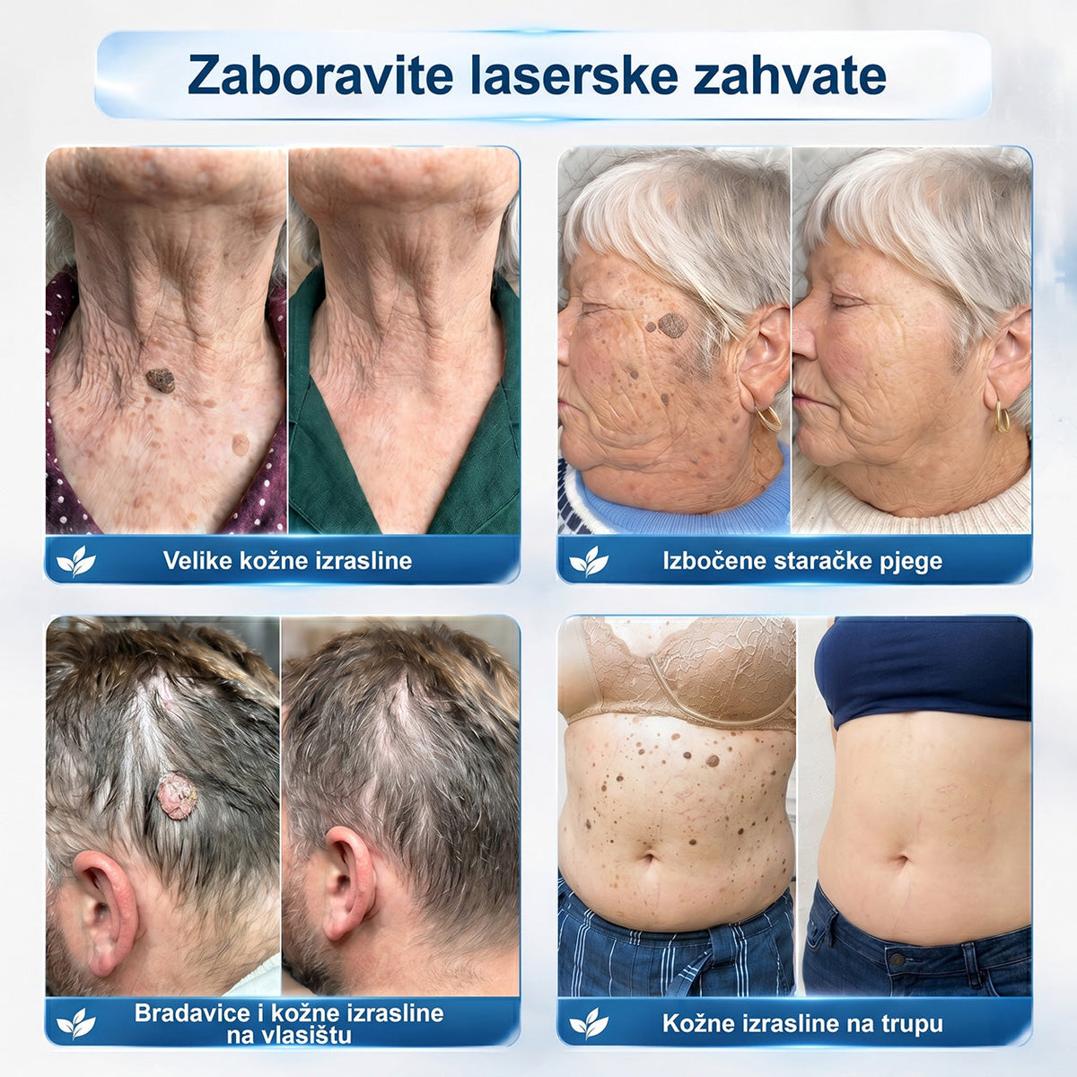 𝑱𝒆𝒅𝒊𝒏𝒂 𝒔𝒍𝒖ž𝒃𝒆𝒏𝒂 𝒕𝒓𝒈𝒐𝒗𝒊𝒏𝒂 | ✅️👩‍⚕️𝐏i𝐜𝐝o® 7 Dana Uklanjač mrlja i kožnih izraslina (Bezbolni roll-on aplikator bez ožiljaka) 🍐