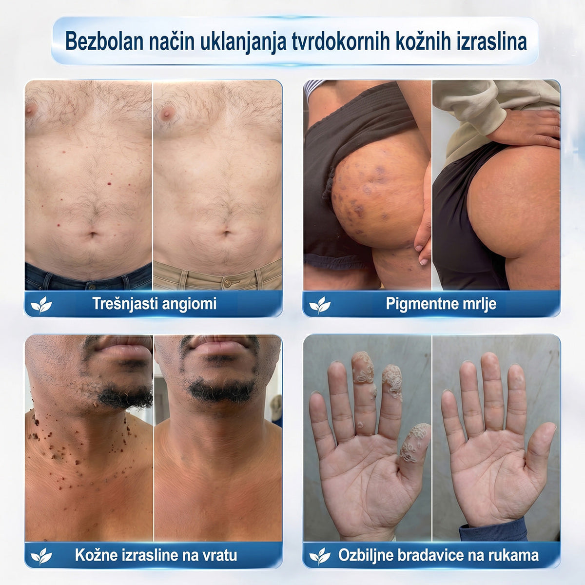 𝑱𝒆𝒅𝒊𝒏𝒂 𝒔𝒍𝒖ž𝒃𝒆𝒏𝒂 𝒕𝒓𝒈𝒐𝒗𝒊𝒏𝒂 | ✅️👩‍⚕️𝐏i𝐜𝐝o® 7 Dana Uklanjač mrlja i kožnih izraslina (Bezbolni roll-on aplikator bez ožiljaka) 🍐