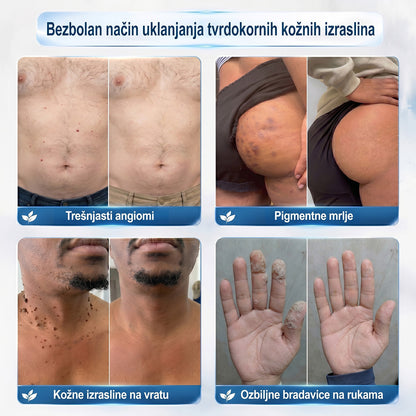 𝑱𝒆𝒅𝒊𝒏𝒂 𝒔𝒍𝒖ž𝒃𝒆𝒏𝒂 𝒕𝒓𝒈𝒐𝒗𝒊𝒏𝒂 | ✅️👩‍⚕️𝐏i𝐜𝐝o® 7 Dana Uklanjač mrlja i kožnih izraslina (Bezbolni roll-on aplikator bez ožiljaka) 🍐