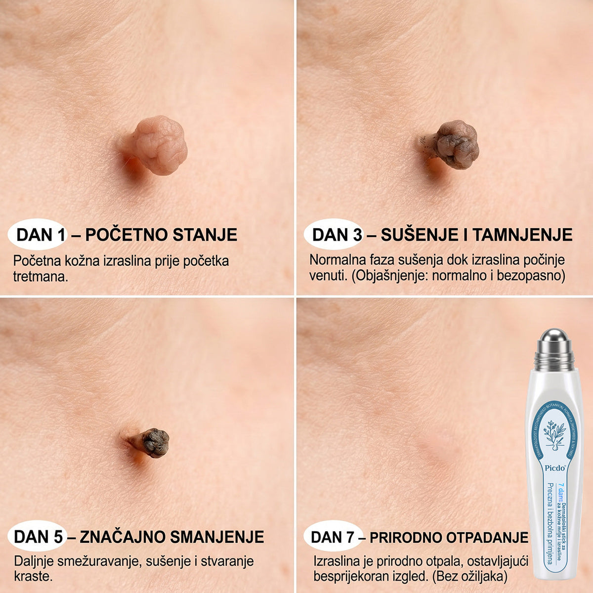 𝑱𝒆𝒅𝒊𝒏𝒂 𝒔𝒍𝒖ž𝒃𝒆𝒏𝒂 𝒕𝒓𝒈𝒐𝒗𝒊𝒏𝒂 | ✅️👩‍⚕️𝐏i𝐜𝐝o® 7 Dana Uklanjač mrlja i kožnih izraslina (Bezbolni roll-on aplikator bez ožiljaka) 🍐