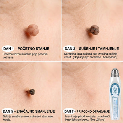 𝑱𝒆𝒅𝒊𝒏𝒂 𝒔𝒍𝒖ž𝒃𝒆𝒏𝒂 𝒕𝒓𝒈𝒐𝒗𝒊𝒏𝒂 | ✅️👩‍⚕️𝐏i𝐜𝐝o® 7 Dana Uklanjač mrlja i kožnih izraslina (Bezbolni roll-on aplikator bez ožiljaka) 🍐