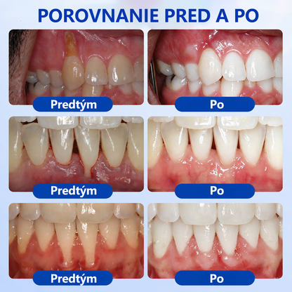 🇪🇺🏅🦷 Evolvion® GumRevive Gel za obnovu parodonta📦